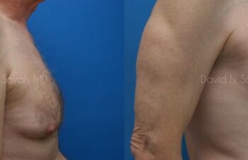 Male Breast Surgery Before and After | Sayah Institute