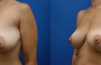 Breast Lift Before and After | Sayah Institute