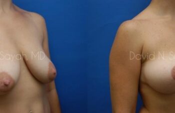 Breast Lift Before and After | Sayah Institute