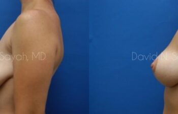 Breast Lift Before and After | Sayah Institute