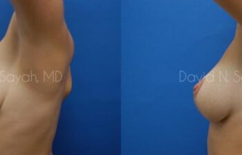 Breast Lift Before and After | Sayah Institute