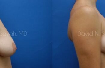 Breast Lift Before and After | Sayah Institute