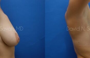 Breast Lift Before and After | Sayah Institute