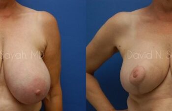 Breast Reduction Before and After | Sayah Institute