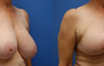 Breast Reduction Before and After | Sayah Institute