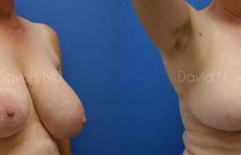 Breast Reduction Before and After | Sayah Institute
