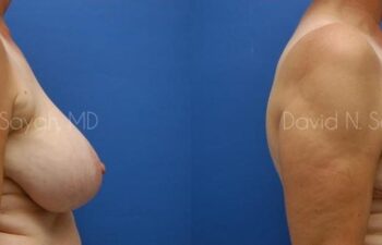 Breast Reduction Before and After | Sayah Institute