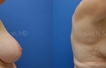 Breast Reduction Before and After | Sayah Institute