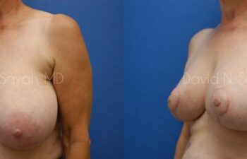 Breast Reduction Before and After | Sayah Institute