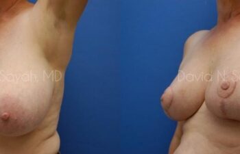 Breast Reduction Before and After | Sayah Institute