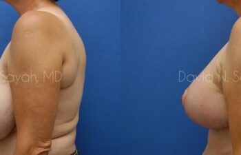 Breast Reduction Before and After | Sayah Institute