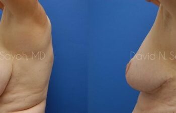 Breast Reduction Before and After | Sayah Institute