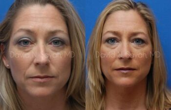 Rhinoplasty Before and After | Sayah Institute