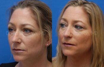 Rhinoplasty Before and After | Sayah Institute