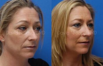 Rhinoplasty Before and After | Sayah Institute