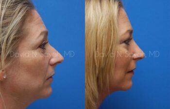 Rhinoplasty Before and After | Sayah Institute