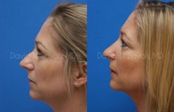 Rhinoplasty Before and After | Sayah Institute