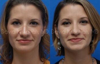 Rhinoplasty Before and After | Sayah Institute