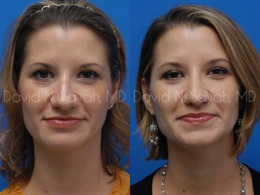 Rhinoplasty Before and After | Sayah Institute