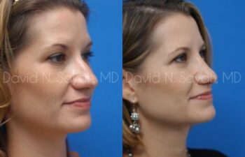 Rhinoplasty Before and After | Sayah Institute