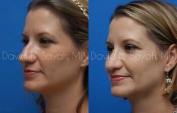 Rhinoplasty Before and After | Sayah Institute
