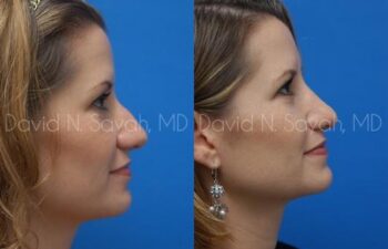 Rhinoplasty Before and After | Sayah Institute