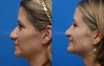 Rhinoplasty Before and After | Sayah Institute