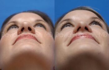 Rhinoplasty Before and After | Sayah Institute