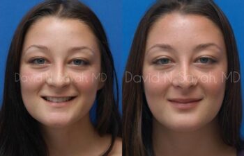 Rhinoplasty Before and After | Sayah Institute
