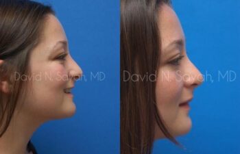 Rhinoplasty Before and After | Sayah Institute