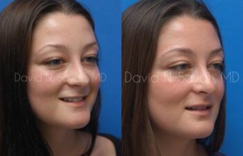 Rhinoplasty Before and After | Sayah Institute