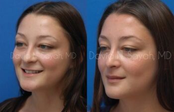 Rhinoplasty Before and After | Sayah Institute