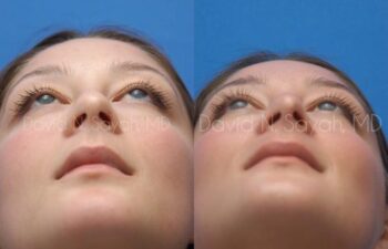 Rhinoplasty Before and After | Sayah Institute