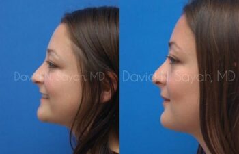 Rhinoplasty Before and After | Sayah Institute
