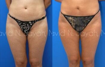 Liposuction Before and After | Sayah Institute