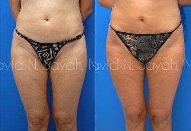Liposuction Before and After | Sayah Institute