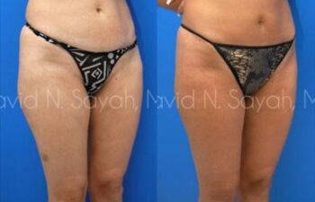 Liposuction Before and After | Sayah Institute