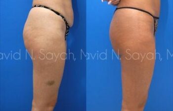 Liposuction Before and After | Sayah Institute