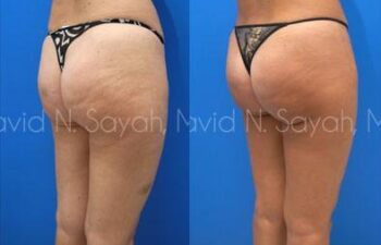 Liposuction Before and After | Sayah Institute