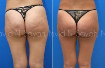 Liposuction Before and After | Sayah Institute