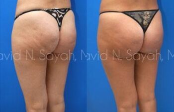 Liposuction Before and After | Sayah Institute