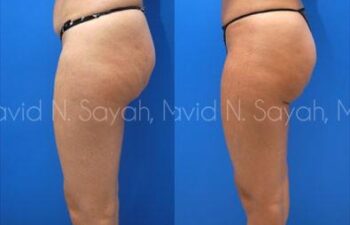 Liposuction Before and After | Sayah Institute