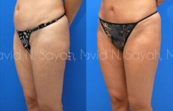 Liposuction Before and After | Sayah Institute