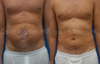 Scar Revision Body Before and After | Sayah Institute