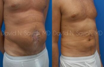 Scar Revision Body Before and After | Sayah Institute