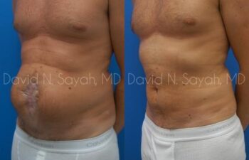 Scar Revision Body Before and After | Sayah Institute