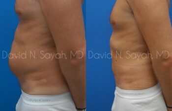 Scar Revision Body Before and After | Sayah Institute