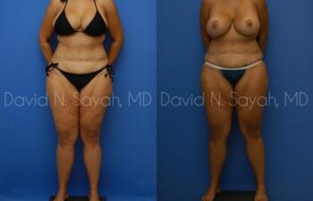 Thigh Lift Before and After | Sayah Institute