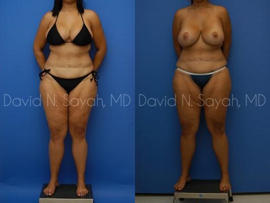 Thigh Lift Before and After | Sayah Institute