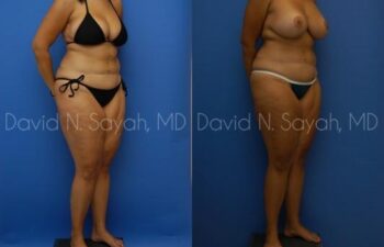 Thigh Lift Before and After | Sayah Institute